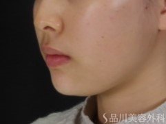 症例NO.72533のAFTER写真