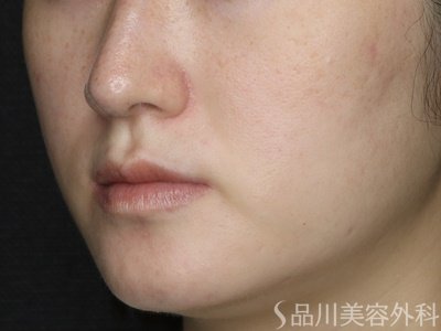 症例NO.73812のAFTER写真