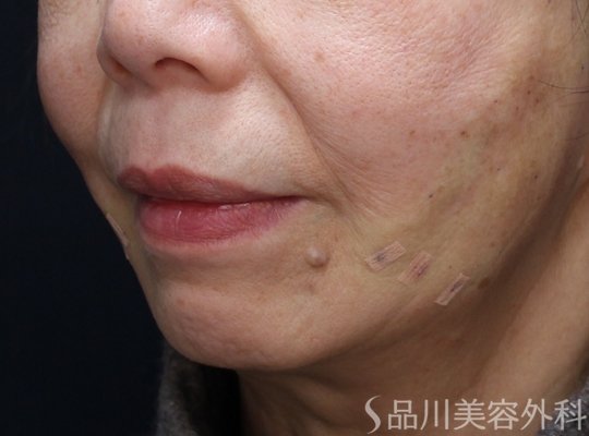 症例NO.73294のAFTER写真