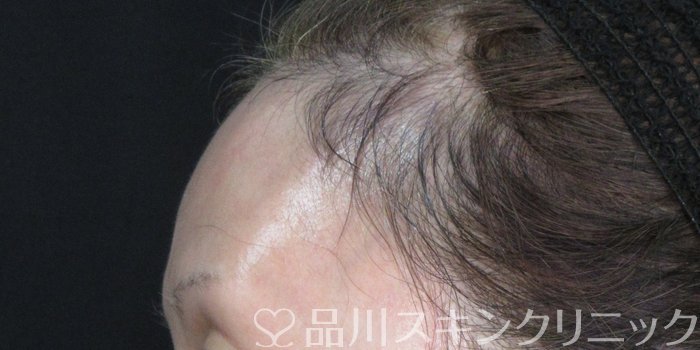 症例NO.74348のBEFORE写真
