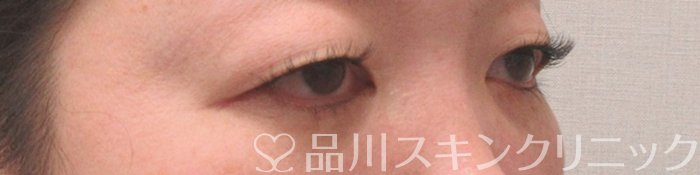 症例NO.73753のBEFORE写真