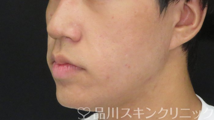 症例NO.71852のAFTER写真