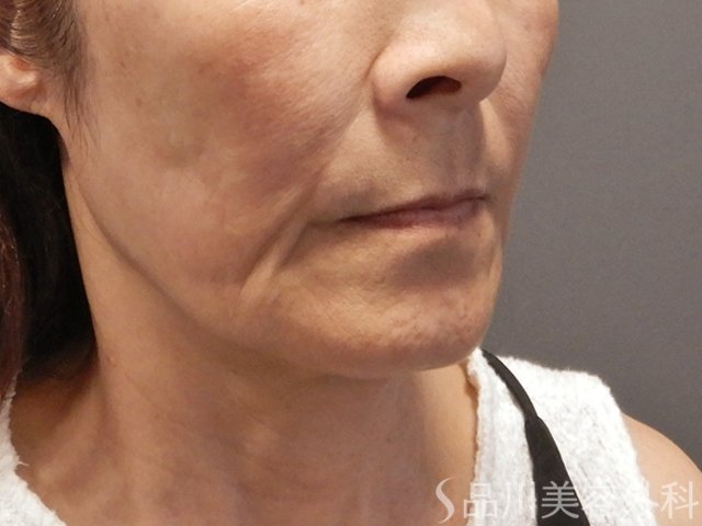 症例NO.71868のBEFORE写真