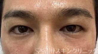 症例NO.69570のBEFORE写真