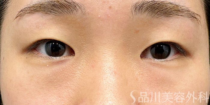症例NO.75234のBEFORE写真