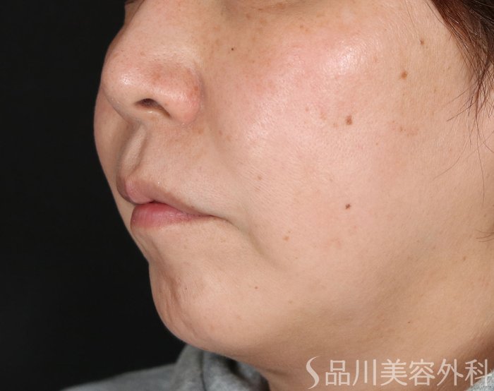 症例NO.72668のBEFORE写真