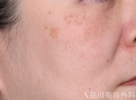 症例NO.74483のBEFORE写真