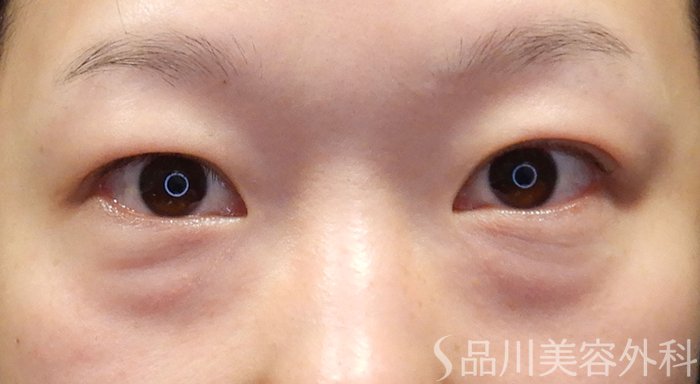 症例NO.70382のBEFORE写真
