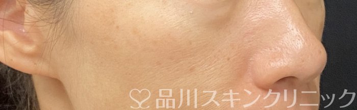 症例NO.74146のAFTER写真
