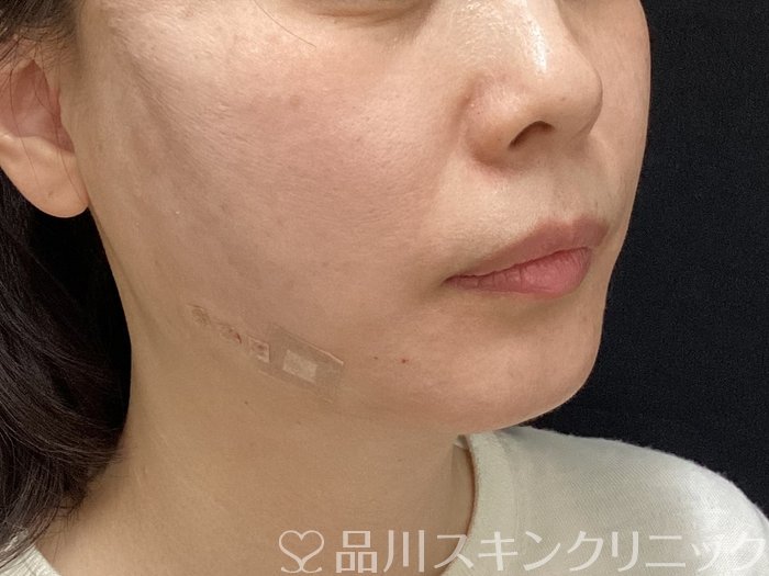 症例NO.69648のAFTER写真