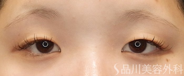 症例NO.69355のBEFORE写真