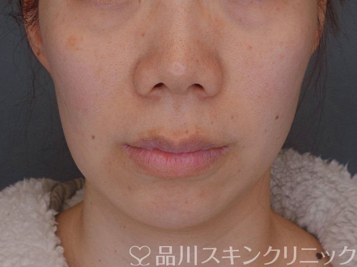 症例NO.74578のBEFORE写真