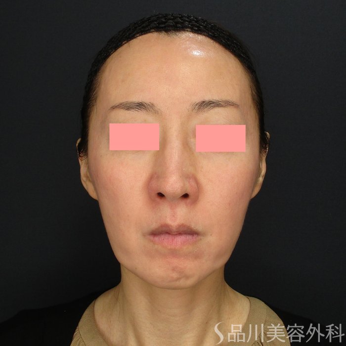 症例NO.71513のBEFORE写真