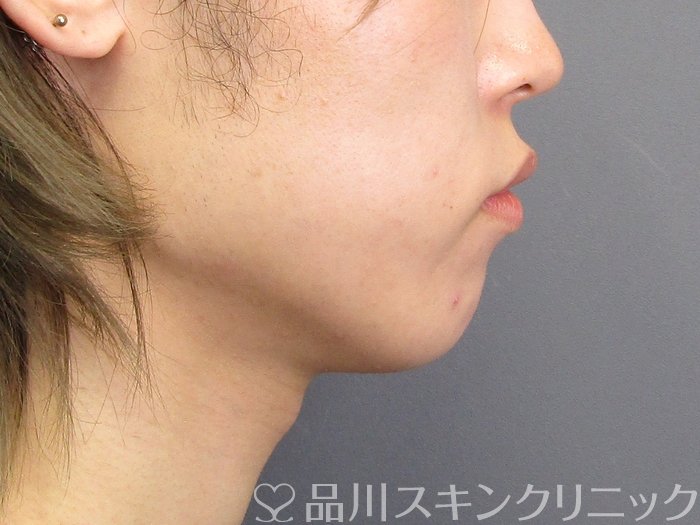 症例NO.75070のBEFORE写真
