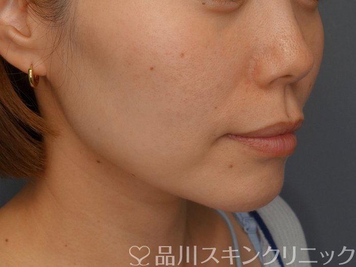 症例NO.74898のBEFORE写真