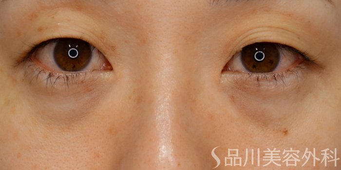 症例NO.70369のBEFORE写真