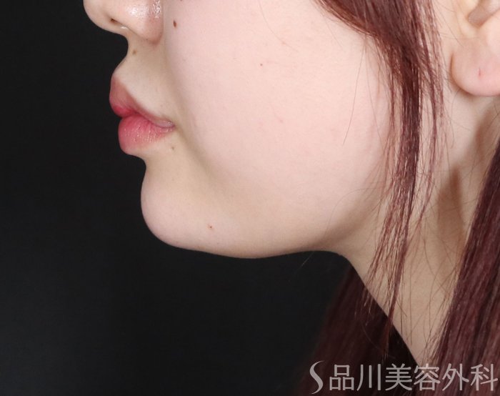 症例NO.72588のAFTER写真