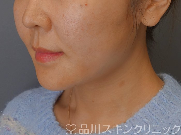 症例NO.72925のAFTER写真