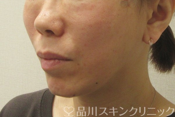 症例NO.75110のAFTER写真