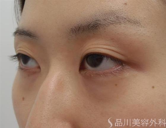 症例NO.7147のBEFORE写真