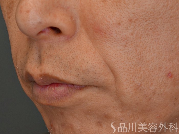 症例NO.67664のBEFORE写真