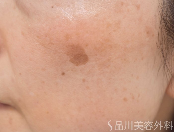 症例NO.66046のBEFORE写真