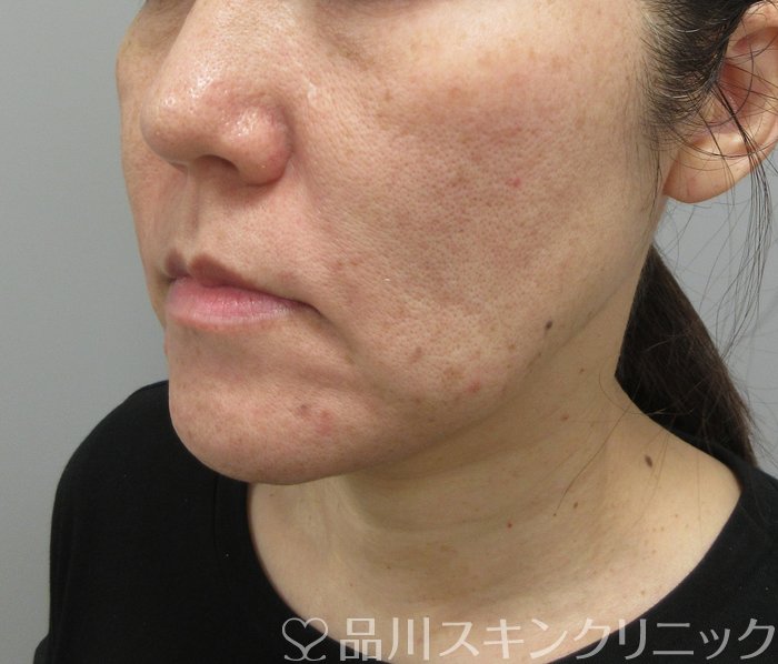 症例NO.73644のBEFORE写真