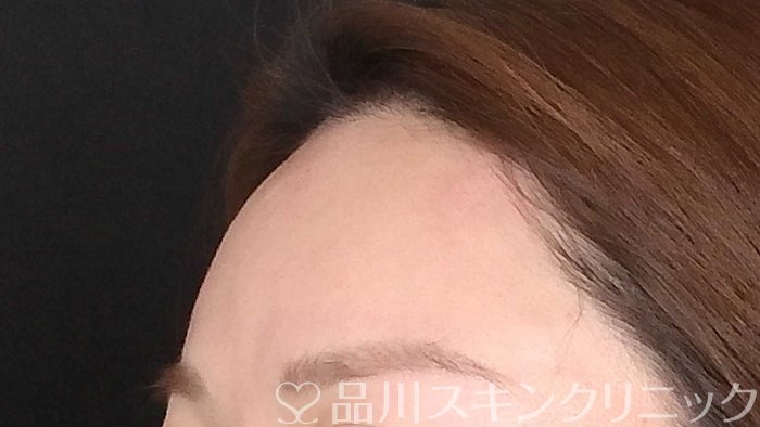 症例NO.72799のAFTER写真