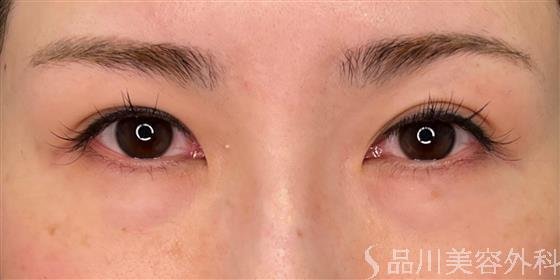 症例NO.54725のBEFORE写真