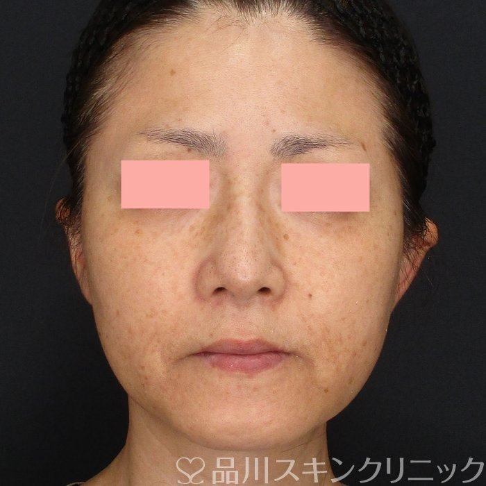 症例NO.72015のBEFORE写真