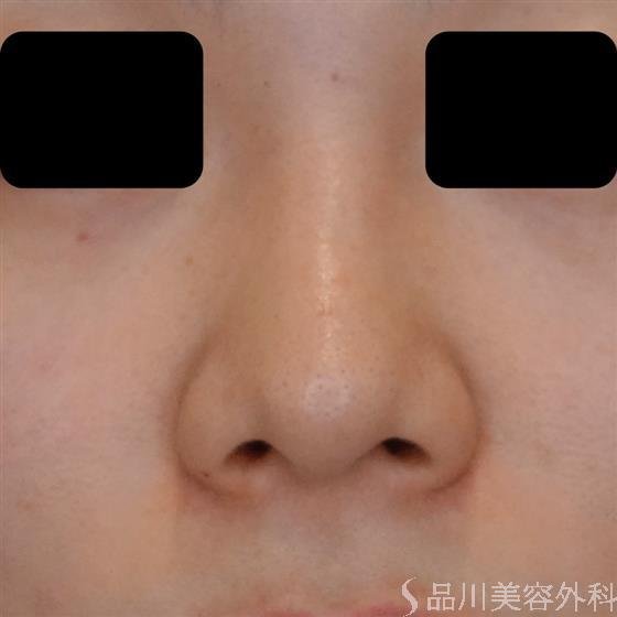 症例NO.50596のBEFORE写真