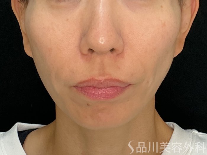 症例NO.72733のBEFORE写真