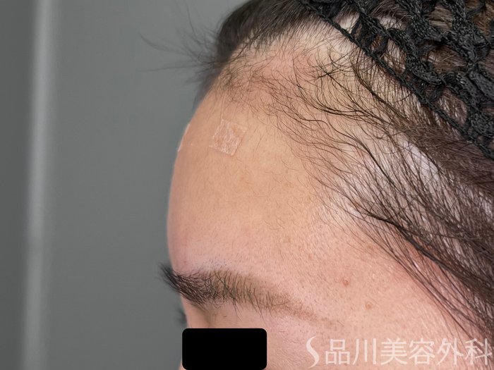 症例NO.70502のAFTER写真