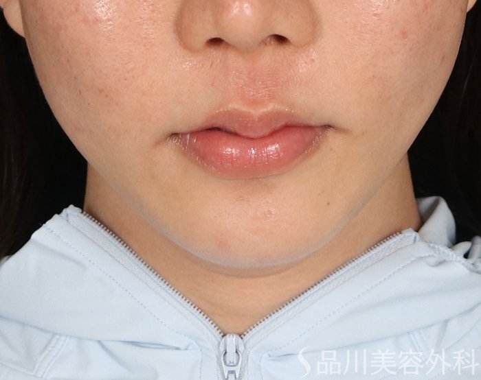 症例NO.73660のAFTER写真