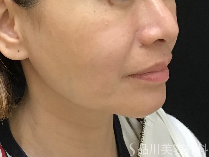 症例NO.69701のBEFORE写真
