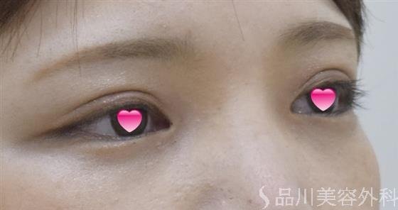 症例NO.53163のAFTER写真