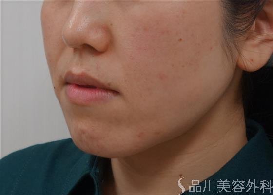 症例NO.39035のBEFORE写真