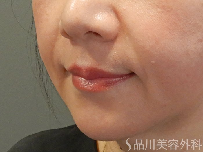 症例NO.70923のBEFORE写真