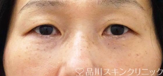 症例NO.49557のAFTER写真