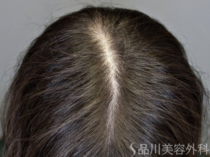 症例NO.72920のAFTER写真