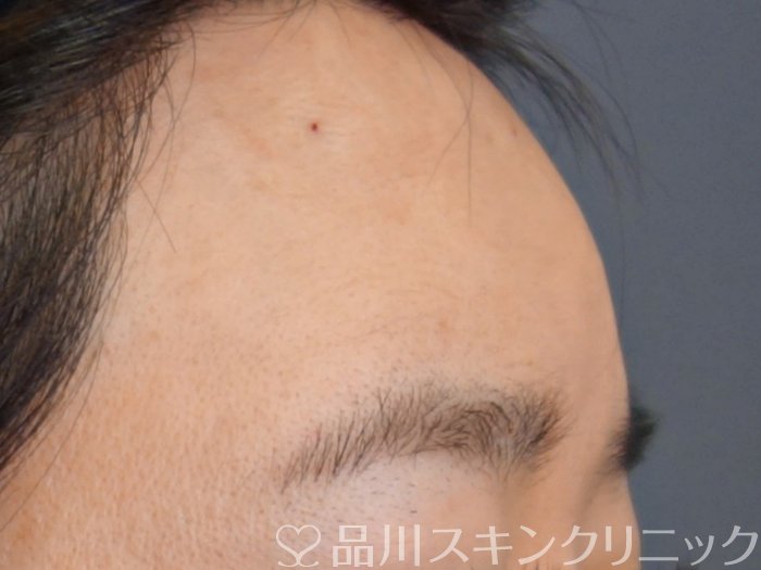 症例NO.73444のAFTER写真