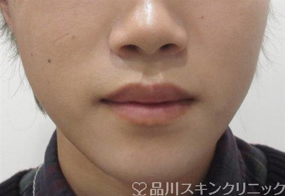 症例NO.30735のAFTER写真