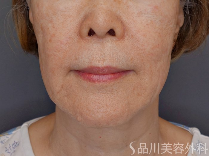 症例NO.71751のBEFORE写真