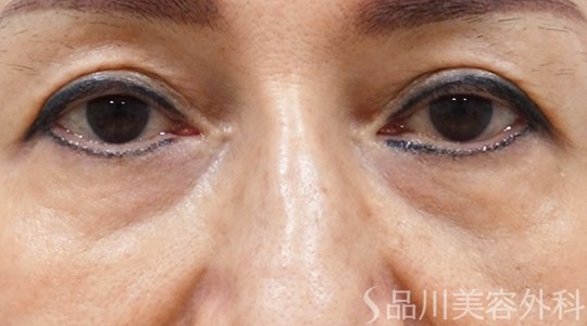 症例NO.72325のBEFORE写真