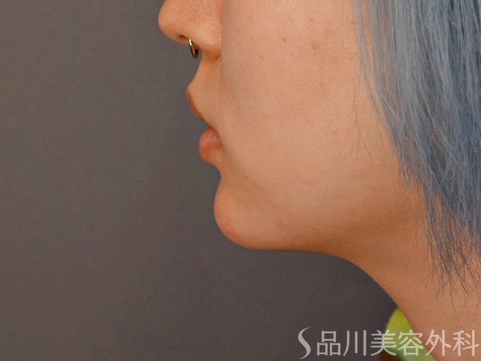 症例NO.70191のAFTER写真