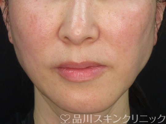 症例NO.72528のAFTER写真