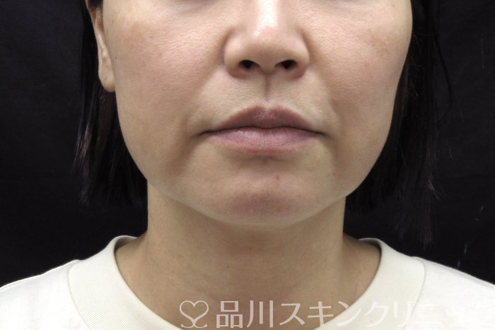 症例NO.74448のBEFORE写真