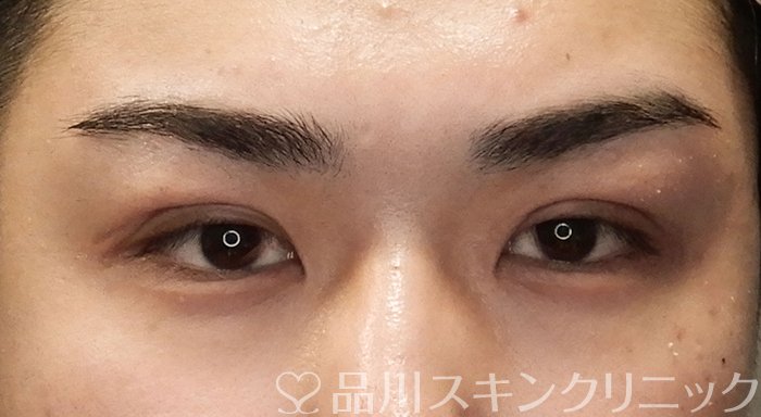 症例NO.70244のAFTER写真