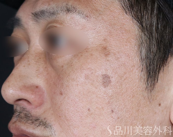 症例NO.73942のBEFORE写真