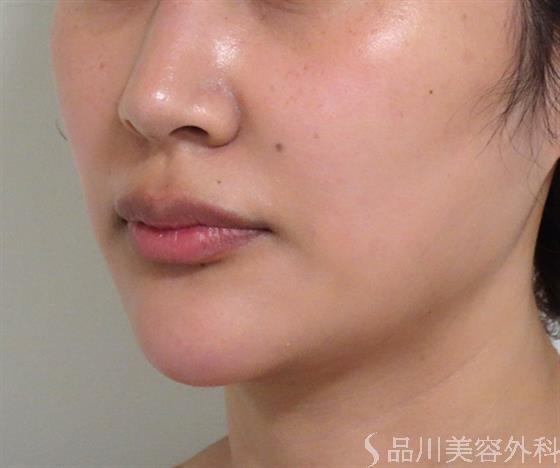 症例NO.38011のAFTER写真
